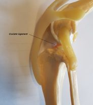 Are a lateral suture and a TPLO ever done together for a dog with cruciate disease?