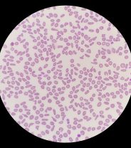 How is anaemia in cats treated?
