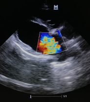 What is pulmonic stenosis in dogs, and can it be fixed? 