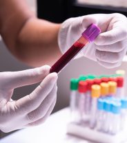 Pre-op bloods – are they really worth it?  